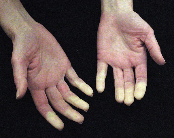 Raynaud's Disease